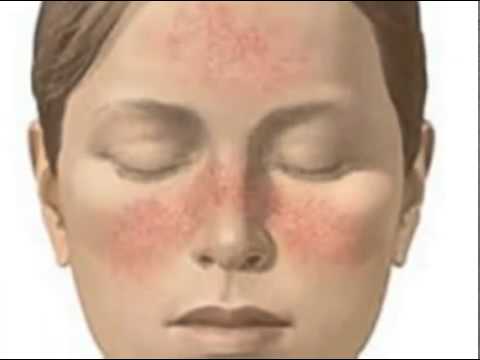 Причины и средства от купероза на лице