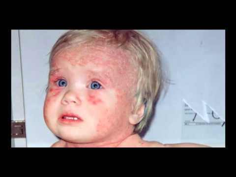 Аллергия на мыло у ребенка и у взрослых
