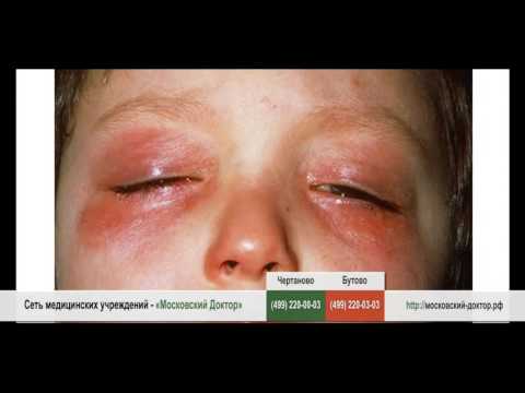 Аллергия на глазах