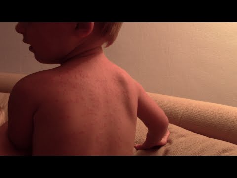 Аллергия на солнце у ребенка. Фотодерматит (фотодерматоз). Наш опыт