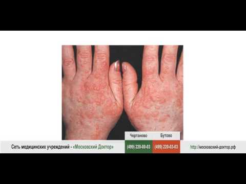 Аллергия на руках у взрослых и детей