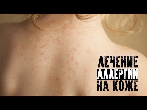 Лечение аллергии на коже