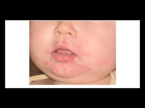 Аллергия на подбородке у ребенка, у взрослых