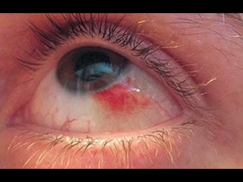 Покраснение глаз: причины их вызывающие и эффективное лечение