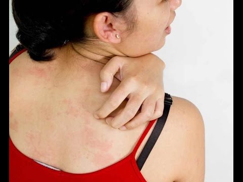 Лечение распространённых проблем кожи и аллергических реакций