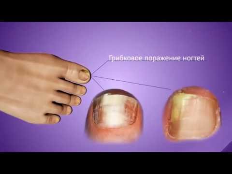 Микозан - эффективное лечение грибка ногтей