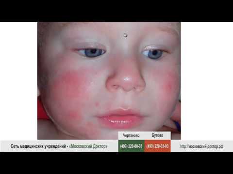 Пятна на лице при аллергии