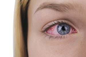 Особенности лечения конъюнктивита глаз у взрослых