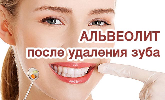 Альвеолит вследствие удаления зуба
