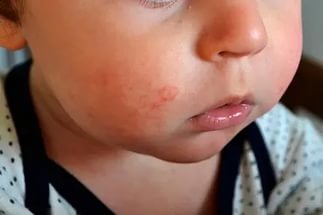 Аллергия на лице у малыша. Психосоматика