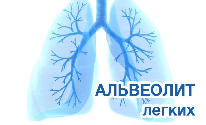 Альвеолит легких: причины и лечнеи