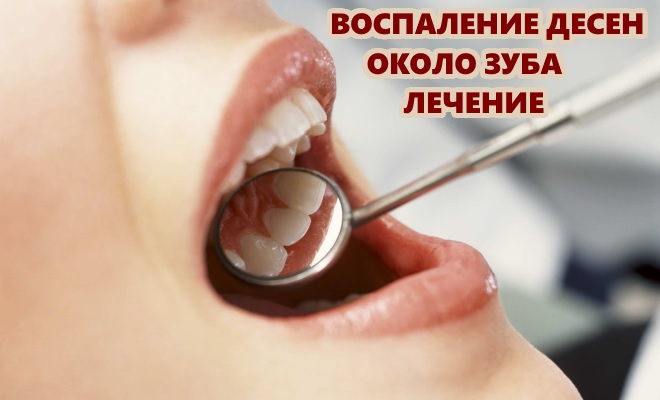 Воспаление десен около зуба - лечение