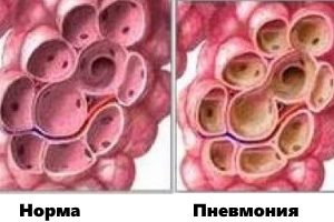 Пневмония