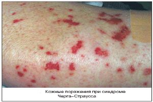 Поражения кожи при синдроме Чарга-Стросса